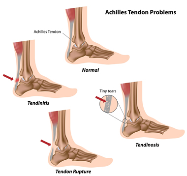 achilles-tendon-problem