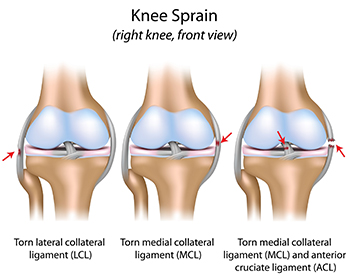 Knee Sprain