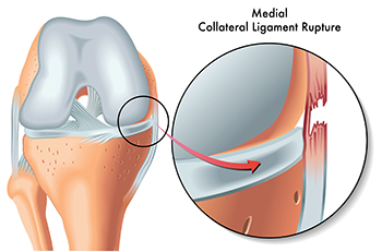 Medial Collateral Ligament Rupture