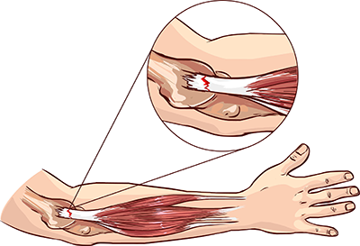 Tendinopathy 