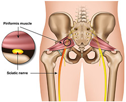 hip-pain