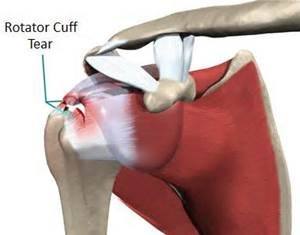 rotator cuff tear